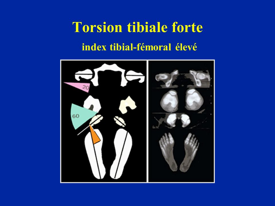 Torsion tibiale forte index tibial-fémoral élevé