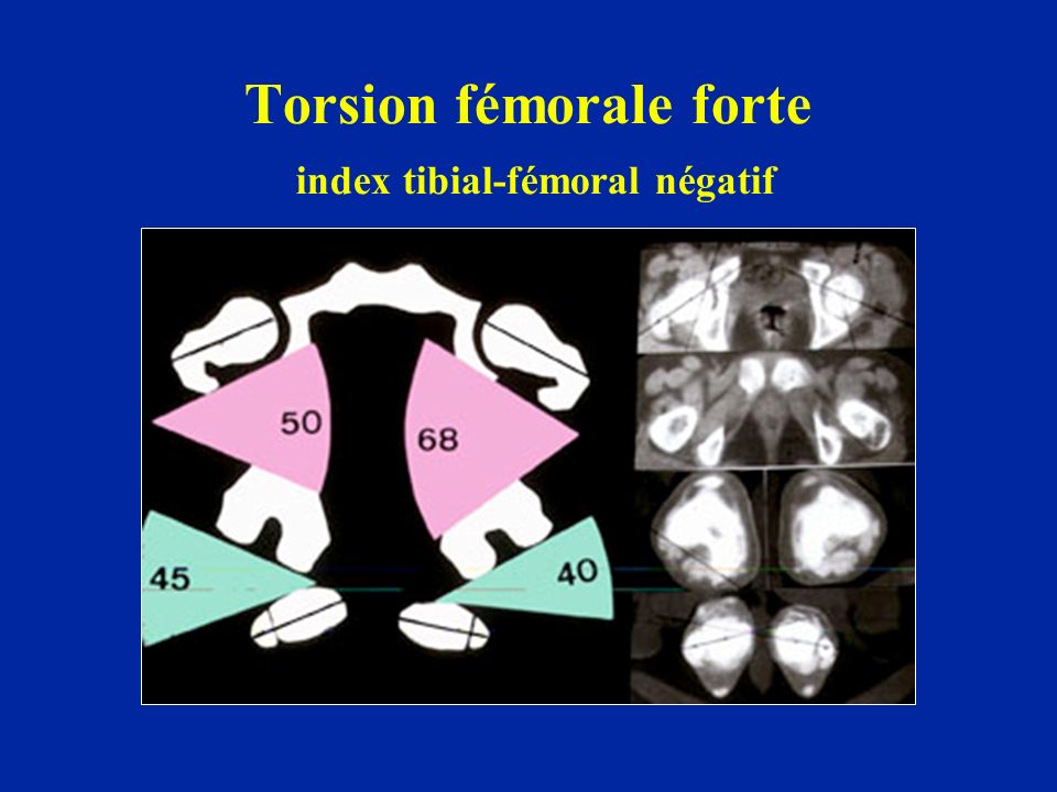 Torsion fémorale forte index tibial-fémoral négatif