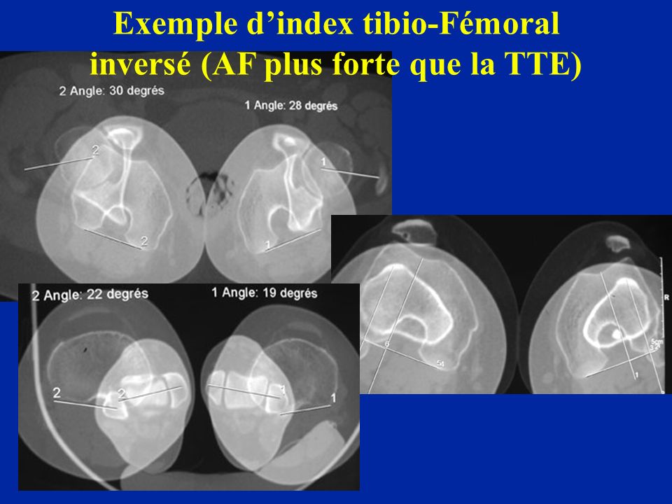 Exemple d’index tibio-Fémoral inversé (AF plus forte que la TTE)