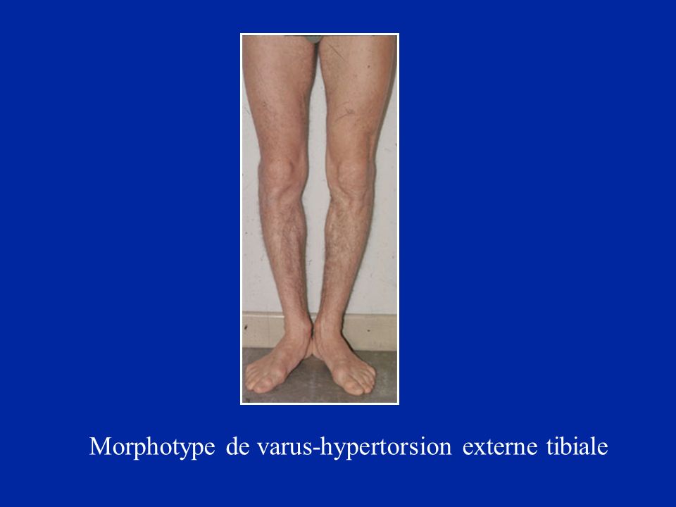 Morphotype de varus-hypertorsion externe tibiale