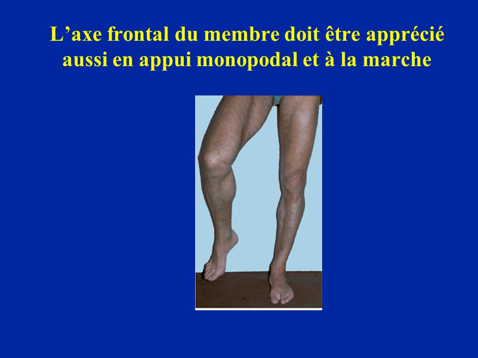 L’axe frontal du membre doit être apprécié aussi en appui monopodal et à la marche