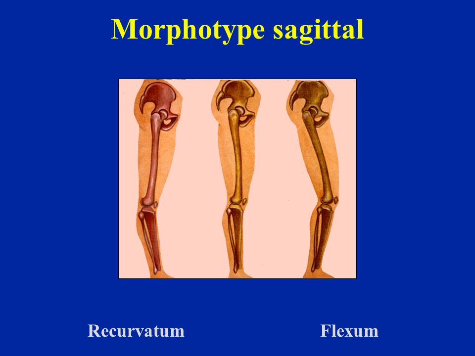 Morphotype sagittal Recurvatum Flexum