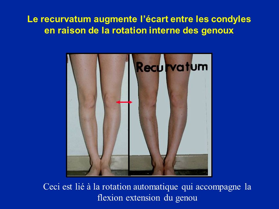 Le recurvatum augmente l’écart entre les condyles en raison de la rotation interne des genoux