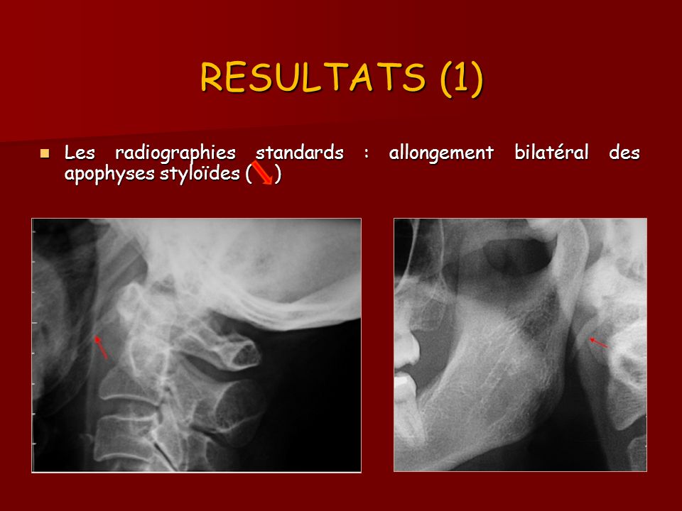 RESULTATS (1) Les radiographies standards : allongement bilatéral des apophyses styloïdes ( )