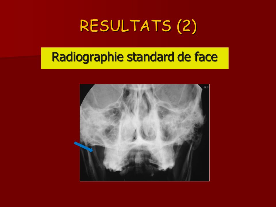 RESULTATS (2) Radiographie standard de face