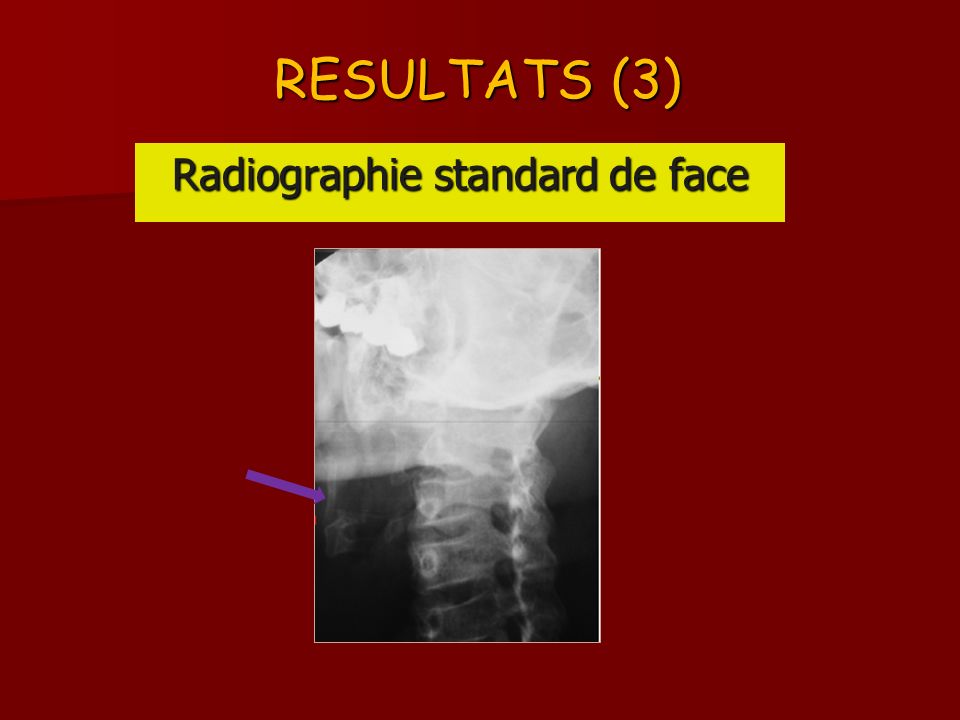 RESULTATS (3) Radiographie standard de face