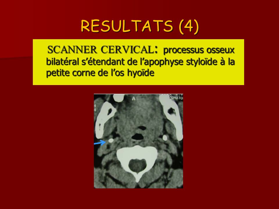 RESULTATS (4) SCANNER CERVICAL: processus osseux bilatéral s’étendant de l’apophyse styloïde à la petite corne de l’os hyoïde.