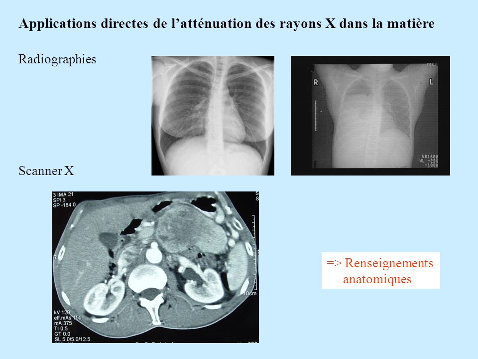 Applications directes de l’atténuation des rayons X dans la matière