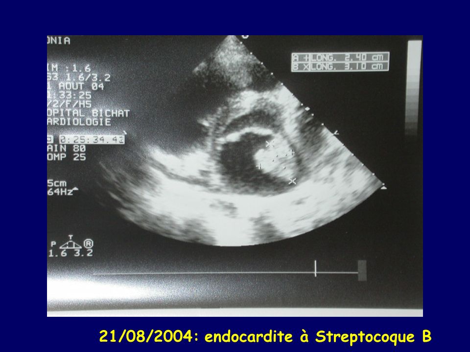 21/08/2004: endocardite à Streptocoque B