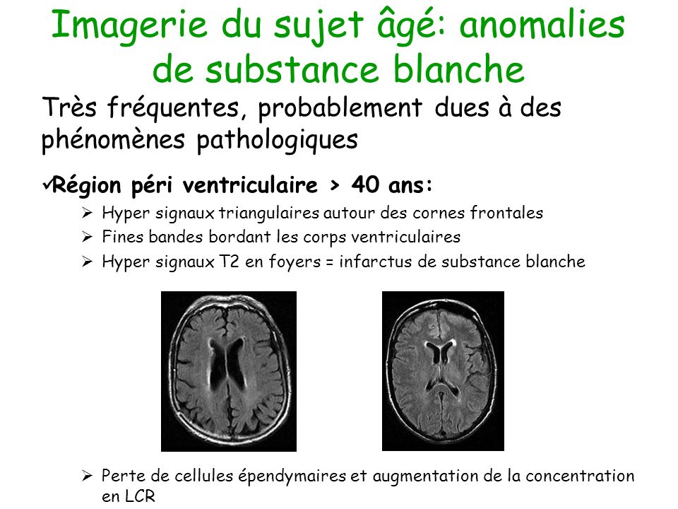 Imagerie cérébrale chez le sujet âgé Lille 2 et 3 décembre ppt ...