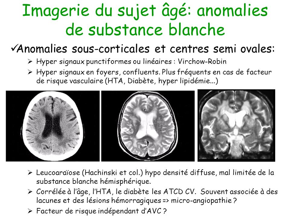 Imagerie cérébrale chez le sujet âgé Lille 2 et 3 décembre ppt ...