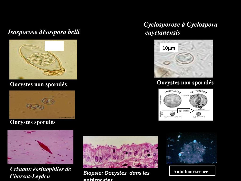 Cyclosporose à Cyclospora cayetanensis Isosporose àIsospora belli