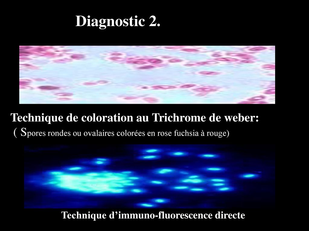 Diagnostic 2. Technique de coloration au Trichrome de weber: