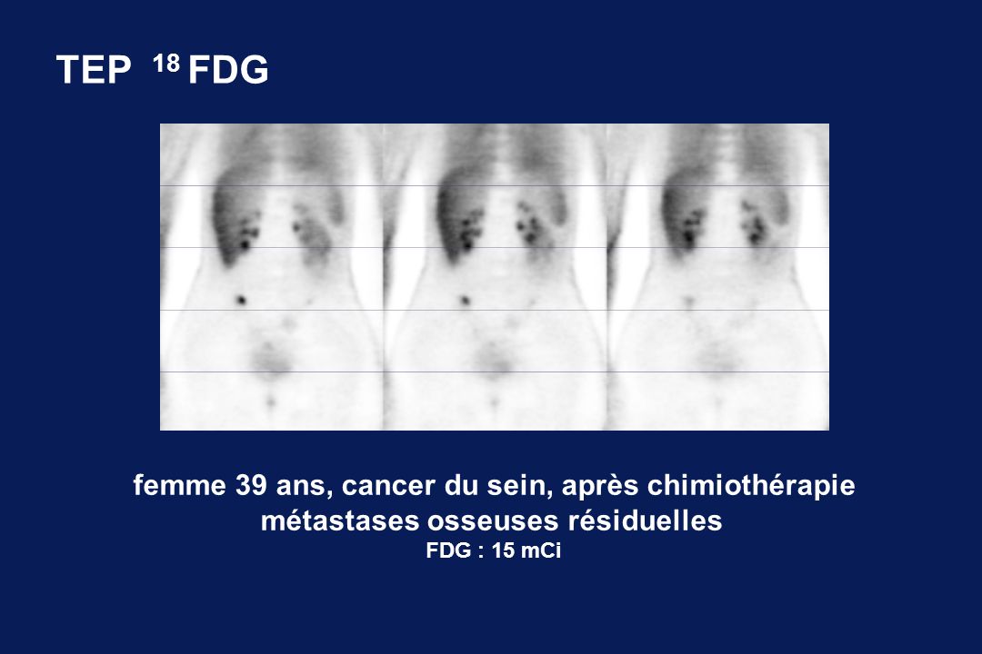TEP 18 FDG femme 39 ans, cancer du sein, après chimiothérapie