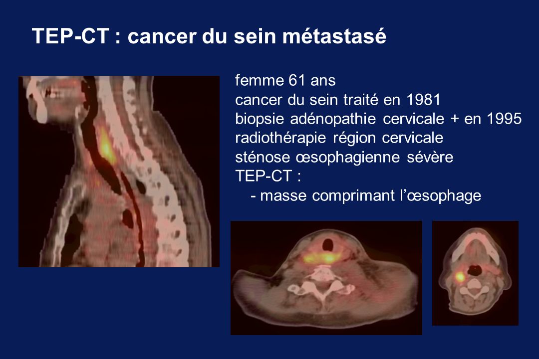 TEP-CT : cancer du sein métastasé