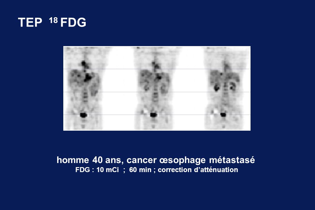 TEP 18 FDG homme 40 ans, cancer œsophage métastasé