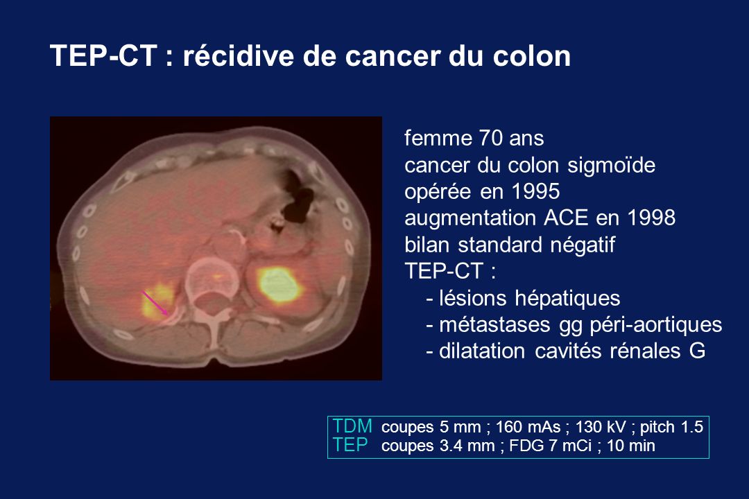 TEP-CT : récidive de cancer du colon