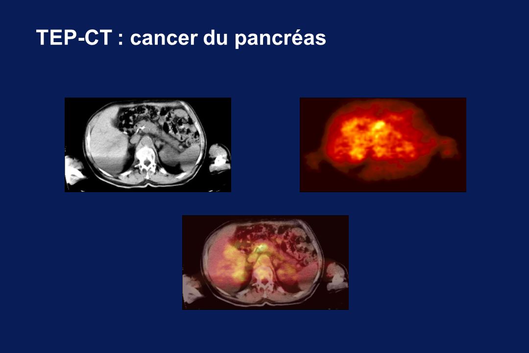 TEP-CT : cancer du pancréas