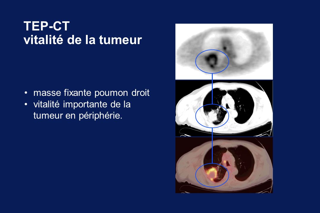 TEP-CT vitalité de la tumeur • masse fixante poumon droit