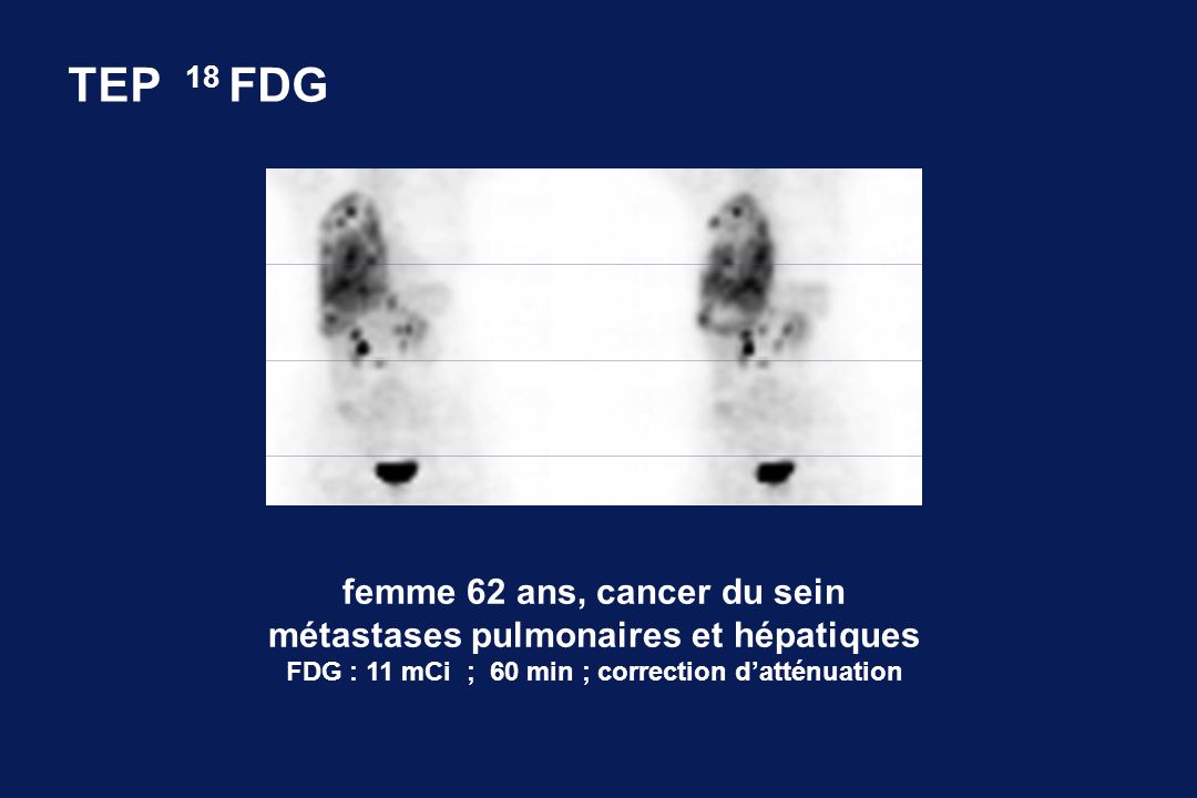 TEP 18 FDG femme 62 ans, cancer du sein