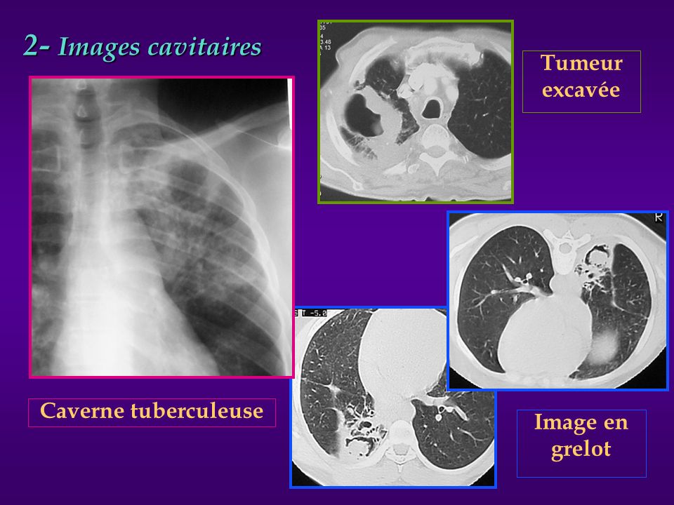 Radiologie Du Thorax Semiologie Eia Pneumologie Pcem2 Partie 2 Ppt Video Online Telecharger