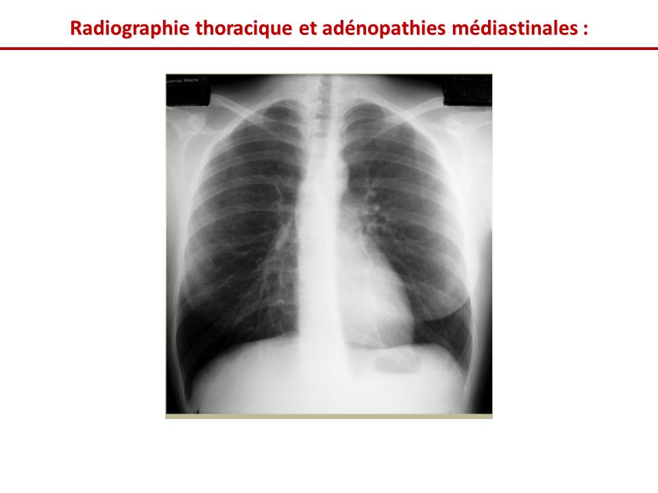 Radiographie thoracique et adénopathies médiastinales :