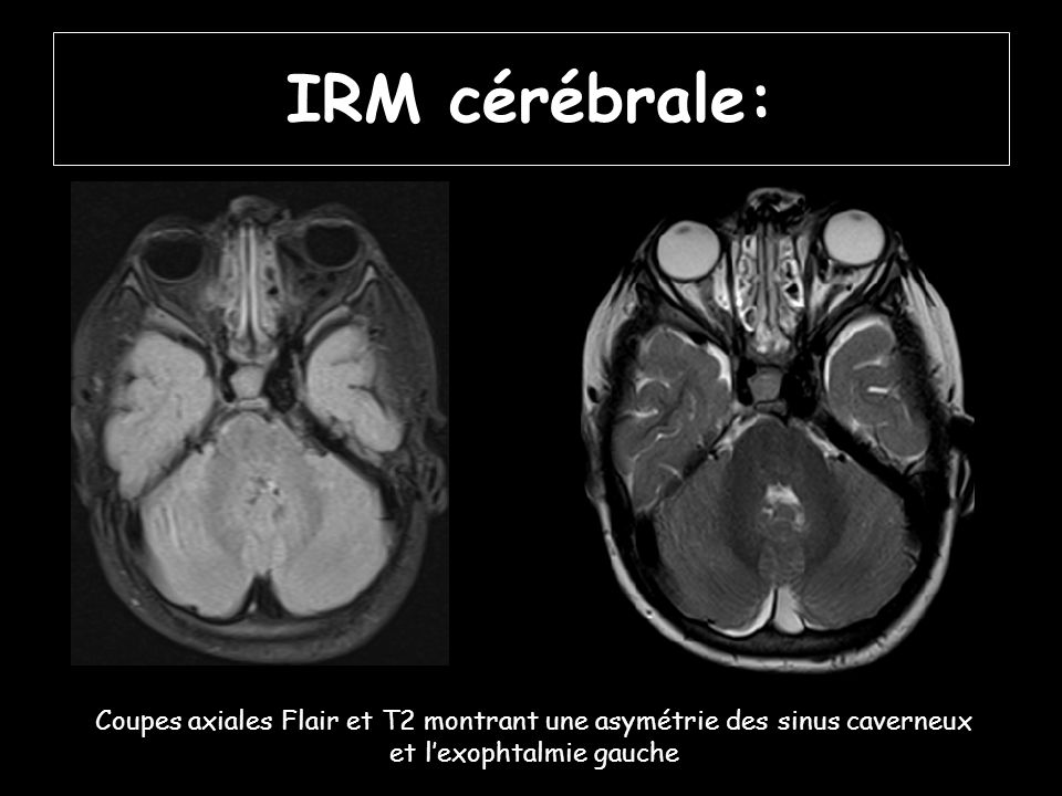 IRM cérébrale: Coupes axiales Flair et T2 montrant une asymétrie des sinus caverneux et l’exophtalmie gauche.