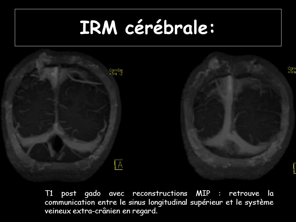 IRM cérébrale: