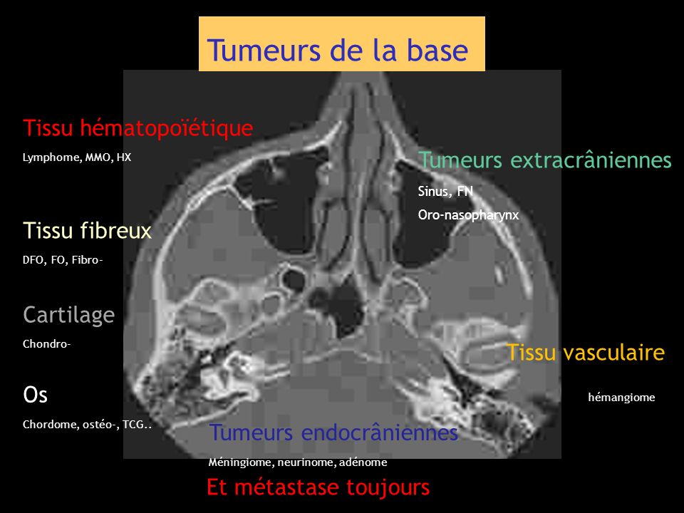 Tumeurs de la base Tissu hématopoïétique Tumeurs extracrâniennes