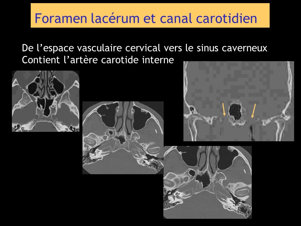 Foramen lacérum et canal carotidien