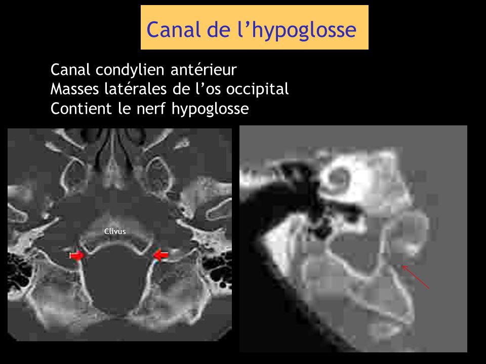 Canal de l’hypoglosse Canal condylien antérieur