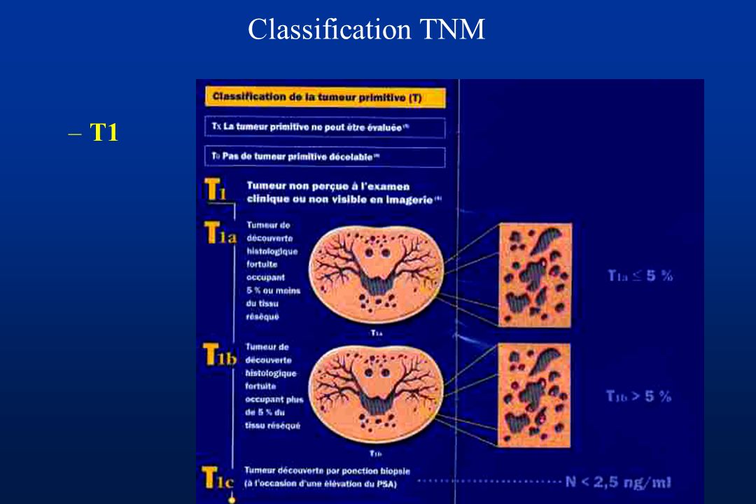 Classification TNM T1