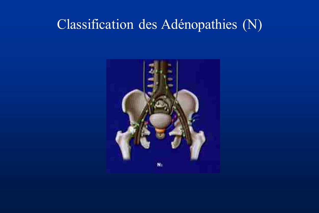 Classification des Adénopathies (N)