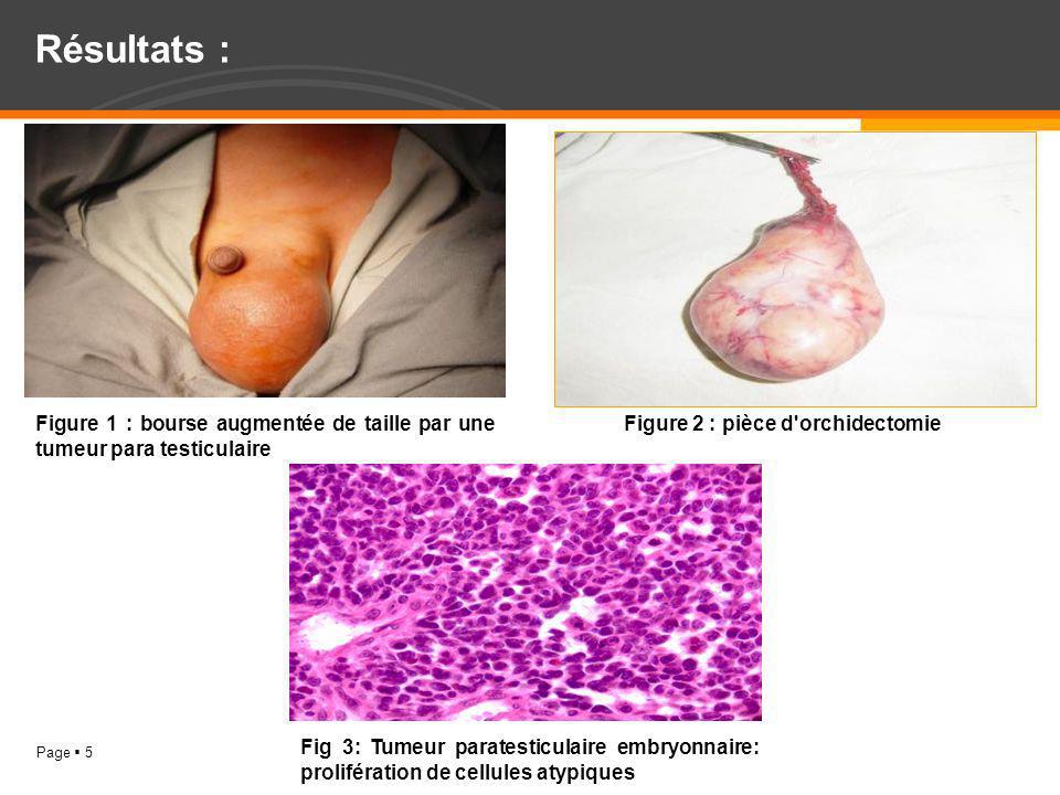 Résultats : Figure 1 : bourse augmentée de taille par une tumeur para testiculaire. Figure 2 : pièce d orchidectomie.