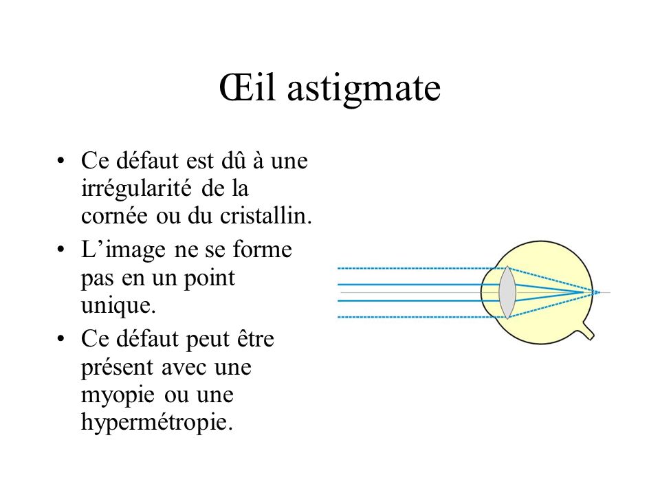 Œil astigmate Ce défaut est dû à une irrégularité de la cornée ou du cristallin. L’image ne se forme pas en un point unique.
