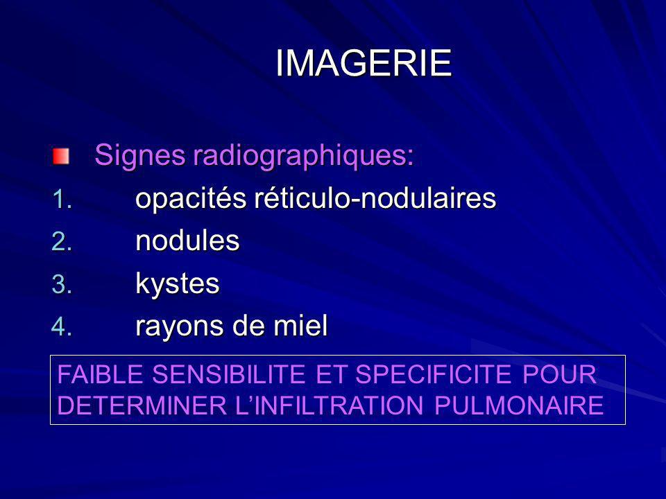IMAGERIE Signes radiographiques: opacités réticulo-nodulaires nodules