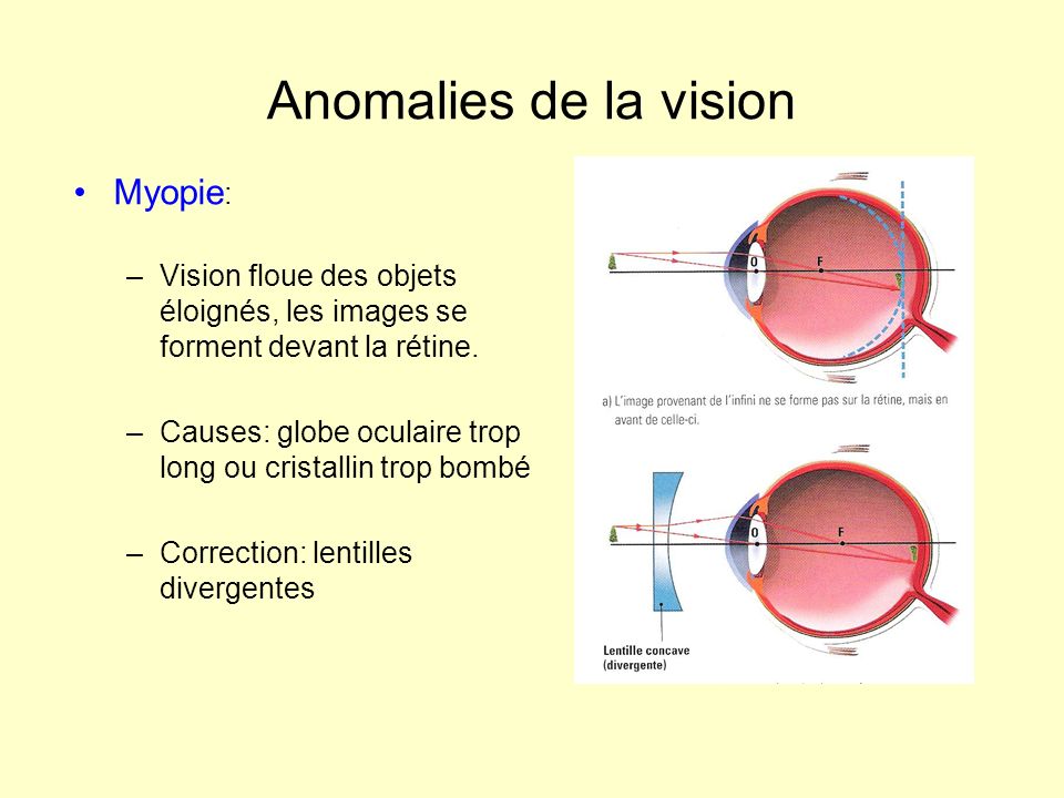 Anomalies de la vision Myopie: