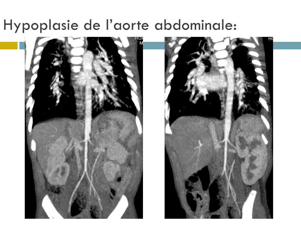 Hypoplasie de l’aorte abdominale: