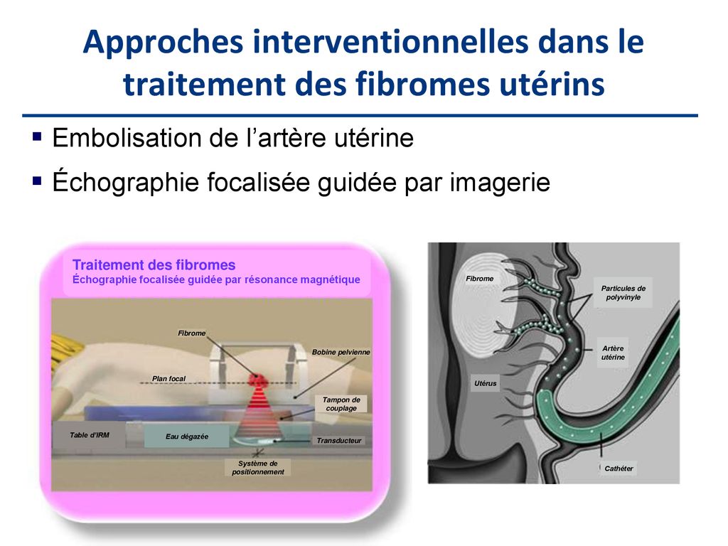 Perles Pearl Cliniques Pour Le Traitement Medical Des Fibromes