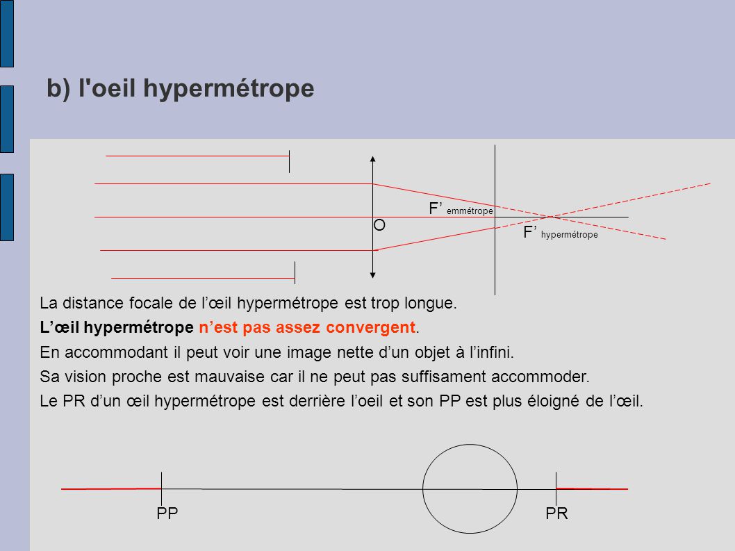 b) l oeil hypermétrope F’ emmétrope O F’ hypermétrope