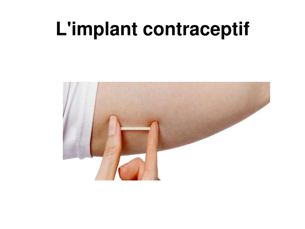 L implant contraceptif