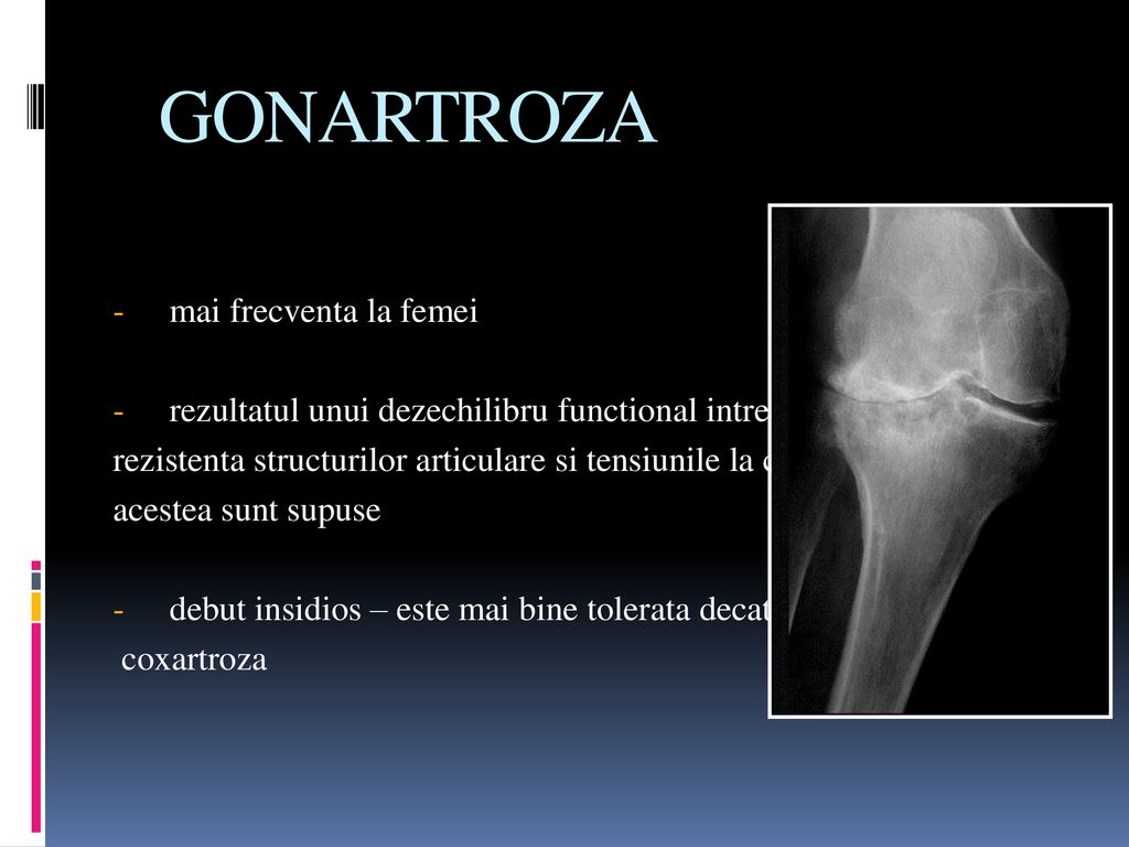 artrita uscata a genunchiului tratamentul inflamației rădăcinilor coloanei vertebrale