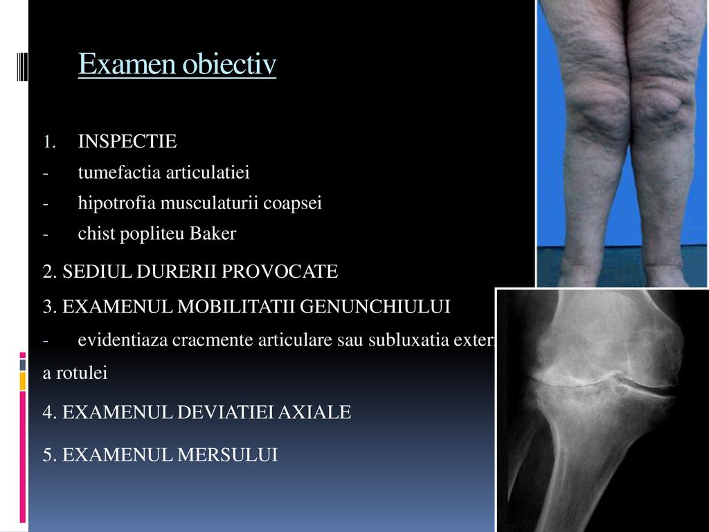 artroza difuză a genunchiului)