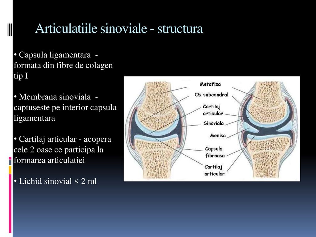 tratamentul sclerozei subcondrale a articulațiilor)