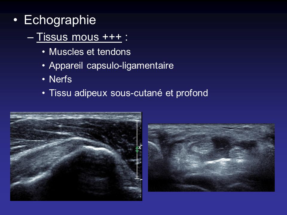 Echographie Tissus mous +++ : Muscles et tendons