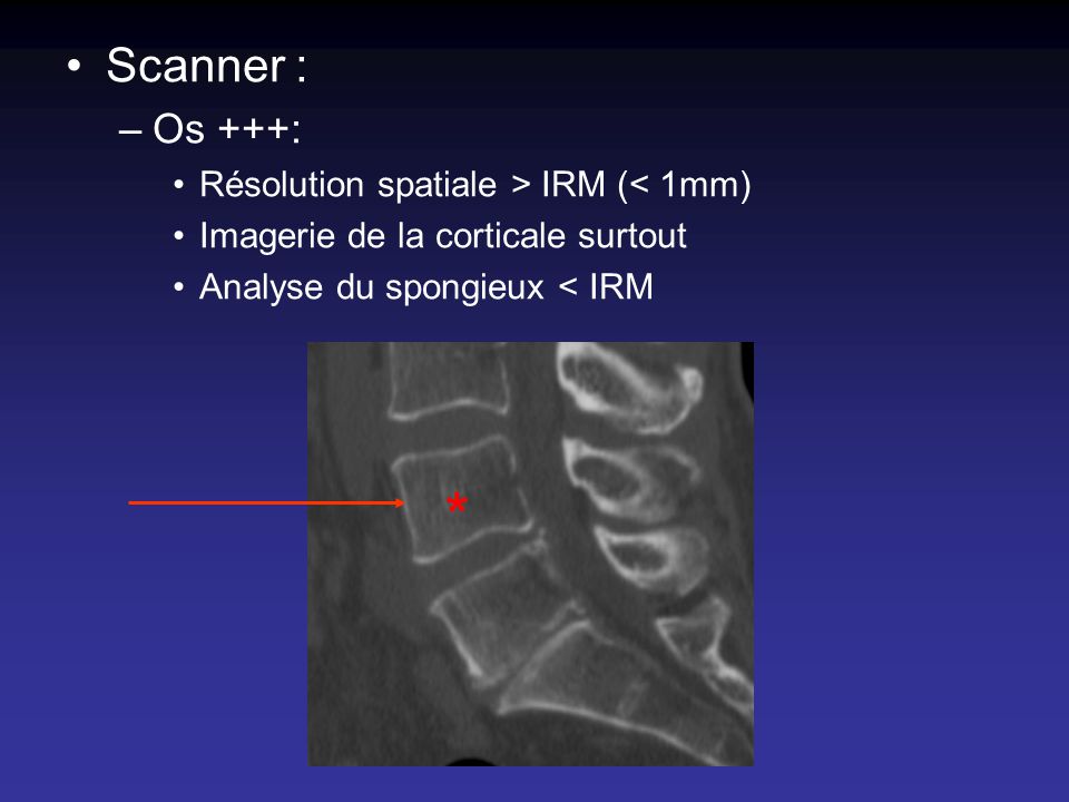* Scanner : Os +++: Résolution spatiale > IRM (< 1mm)