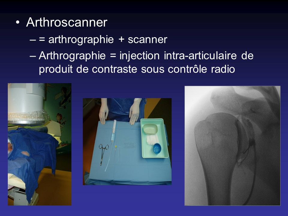 Arthroscanner = arthrographie + scanner