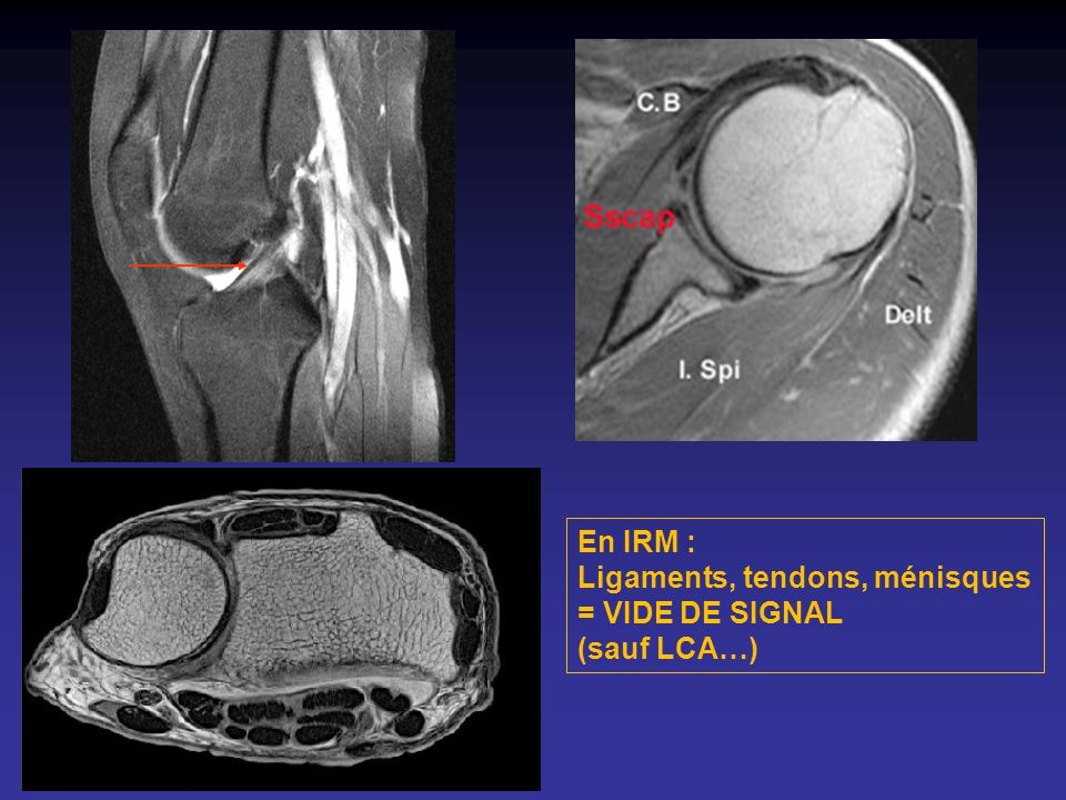 En IRM : Ligaments, tendons, ménisques = VIDE DE SIGNAL (sauf LCA…)