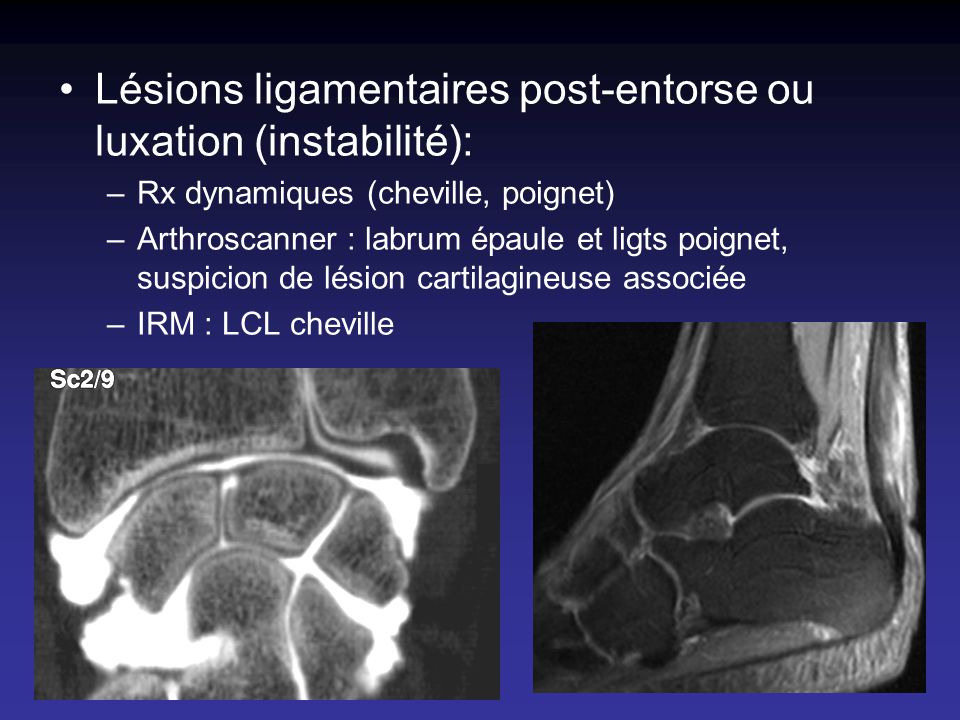Lésions ligamentaires post-entorse ou luxation (instabilité):