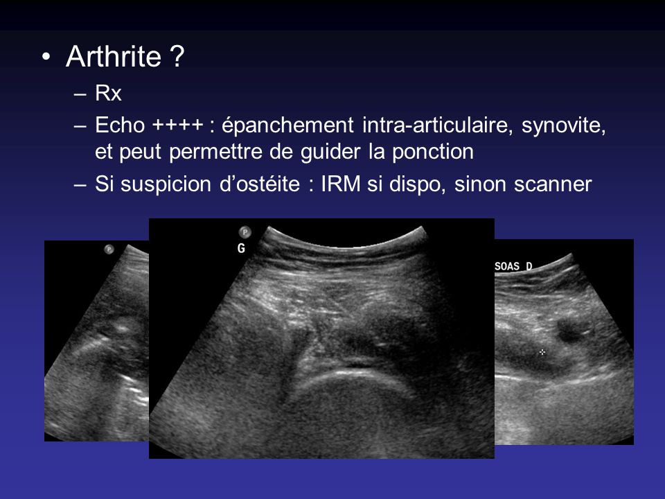 Arthrite Rx. Echo ++++ : épanchement intra-articulaire, synovite, et peut permettre de guider la ponction.